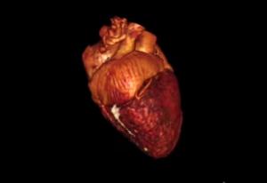 心脏影像技术新突破，可同时3D显示血管和瘢痕组织