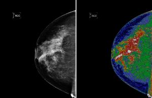一种NASA使用的技术能帮助解释乳房X线、超声等各种影像图像