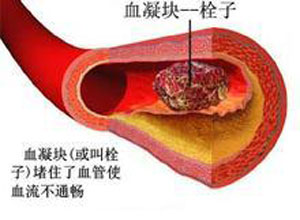 IVIG可有效预防复发性血栓（Clin Exp Rheumatol. 2012 May-Jun;30(3):409-13. Epub 2012 Jun 26）