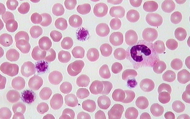 特发性血小板减少性紫癜发病或与幽门螺杆菌感染相关
