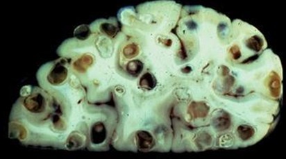 AAN：脑实质型脑囊虫病循证治疗指南发布