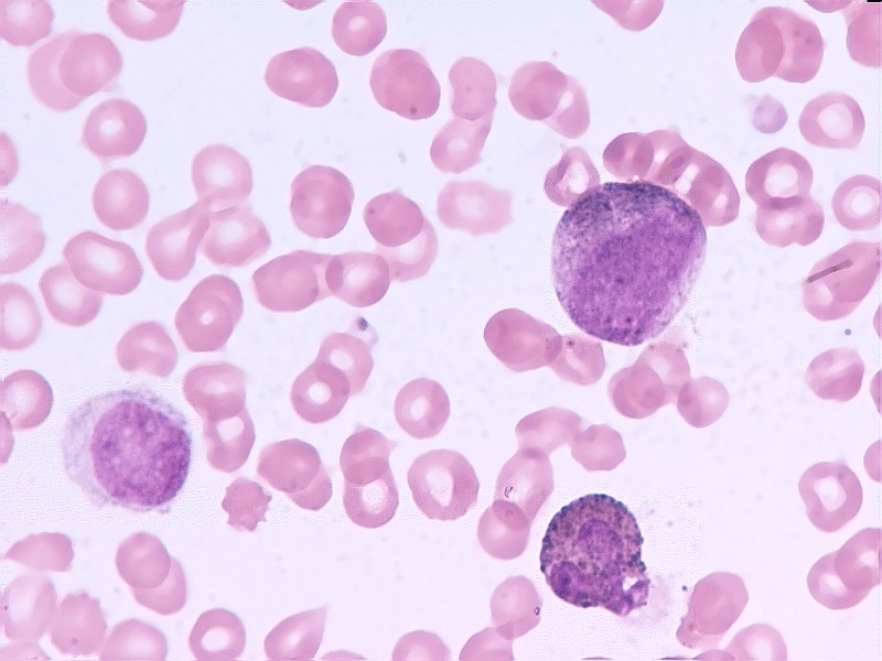 FDA更新达沙替尼治疗慢性粒细胞白血病的标签