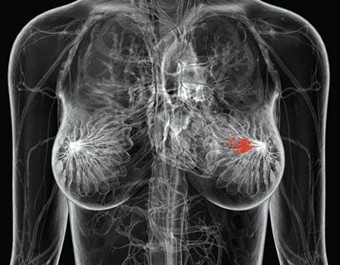 美国临床肿瘤学会更新乳腺癌化学预防指南