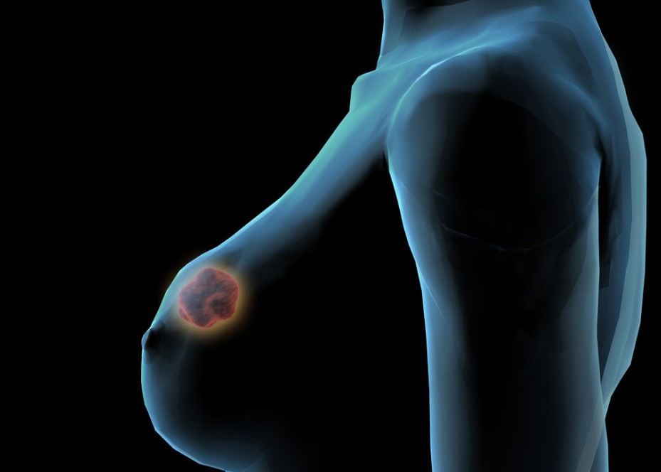 降低乳腺癌骨转移患者唑来膦酸的给药频率可行吗？（Lancet Oncol. 2013 Jun;14(7):663-70.）