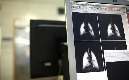 超级化MRI或能尽早发现肺癌