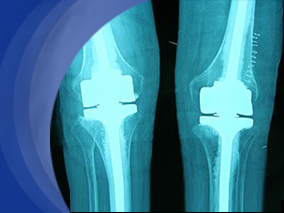 全膝置换术后疼痛的强度是运动时慢性疼痛的一个风险因素
