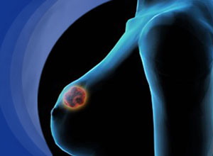 新药Kadcyla或延长乳腺癌女性生存