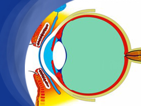 应用抗VEGF减缓但不能完全预防DME患者视网膜毛细血管的阻塞