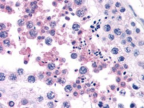 结节性硬化综合征患者使用依维莫司治疗巨细胞星形细胞瘤