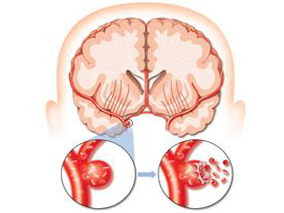 急性轻型脑卒中或TIA：氯吡格雷+阿司匹林优于单用阿司匹林