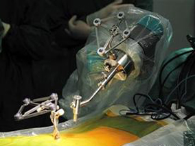 “中国造”骨科手术机器人 精度达到世界级