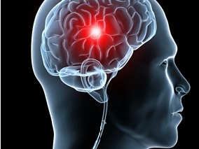 服用OAC的急性缺血性脑卒中患者的血管内治疗是否安全？