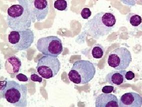 多发性骨髓瘤患者自体HSCT后使用免疫球蛋白能否降低感染风险？