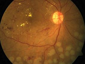 硬性渗出物并非糖尿病黄斑水肿患者视力结局不良的预后指标
