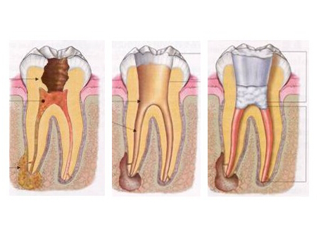 牙髓治疗牙10年存活率约为80%