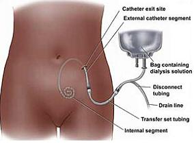 艾考糊精降低腹膜透析患者技术故障并改善患者生存期