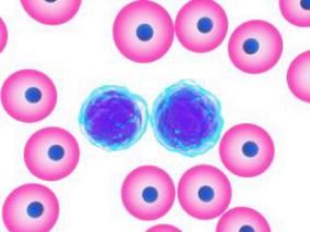 两性霉素B的雾化脂质体预防急性髓系白血病曲霉病的有效性