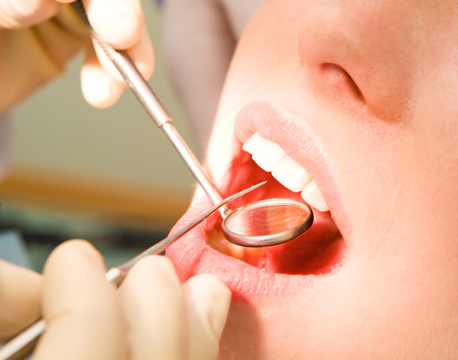 与牙周炎全口评估方案相比 局部口腔评估方案或致分级错误及产生偏倚