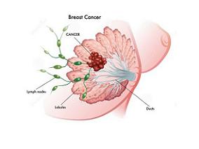 依维莫司+曲妥珠单抗或可用于HER-2阳性晚期乳腺癌患者一线治疗