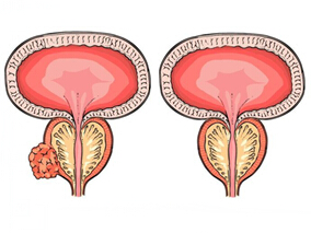 高危前列腺癌患者一线治疗：ADT+多西他赛+雌莫司汀vs ADT