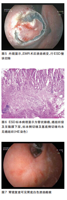 内镜治疗隆起型早期胃癌1例