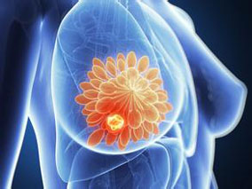 乳腺癌患者辅助性内分泌治疗停药的预测因子