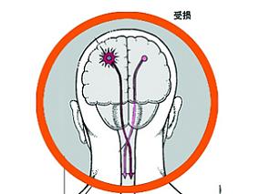 静脉注射阿替普酶是否影响急性缺血性脑卒中患者的死亡率？