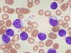 利奈唑胺对新确诊AML患者诱导化疗后血液学指标有何影响？