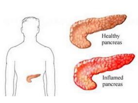 基于肠促胰素的药物不会增加急性胰腺炎的风险