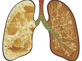 康健教授：特发性肺纤维化发病的危险因素