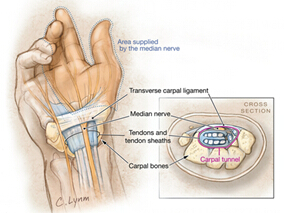 阿那曲唑的使用与较高的腕管综合征发病率相关