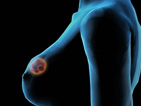 原发性乳腺癌的对侧乳腺癌风险：年龄的影响