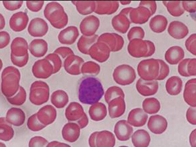 CLL患者ibrutinib治疗期间自身免疫性血细胞减少症的发生率