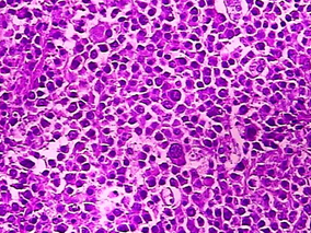 II-IV期滤泡型淋巴瘤：观察等待作初期管理可行吗？