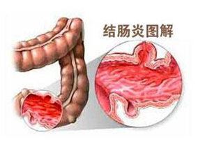 他克莫司和抗TNF治疗难治性溃疡性结肠炎的安全性和有效性