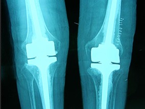 哪种非甾体抗炎药对膝关节炎和髋关节炎疼痛最有效？