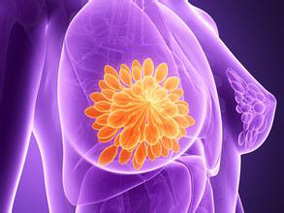 女性乳腺癌患者：MRI筛查的准确性和敏感性