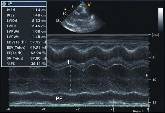 图2‐1‐223 m型超声心动图显示中量心包积液,积液位于左室后壁pe:心