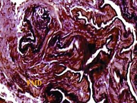 罕见动脉病——纤维肌性结构发育不良两例