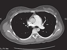 肺动脉段明显突出 就是肺动脉高压吗？