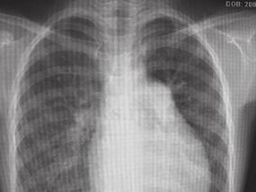 如何鉴别小儿特发性肺动脉高压？