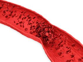 抗栓药物使用增加带来的意外伤害：硬膜下血肿