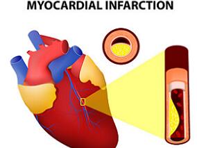 多学科讨论：冠状动脉非阻塞型心梗的二级预防和长期结局如何？