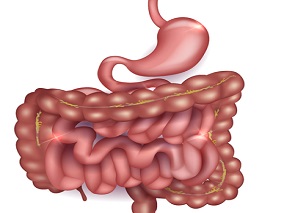 艰难梭菌感染可增加IBD患者长期而非短期结肠清除术风险
