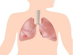 慢性阻塞性肺病：LABA/LAMA还是LABA/ICS？