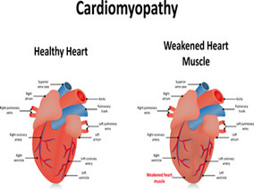 扩张型心肌病常见的心电图改变有哪些？