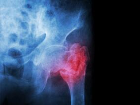 近期股骨转子间骨折的老年患者：特立帕肽vs利塞膦酸钠