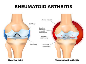 注射曲安奈德可造成膝骨关节炎患者的软骨体积损失？