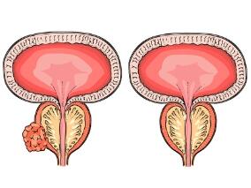 早期前列腺癌切还是不切？近20年的随访来定纷止争