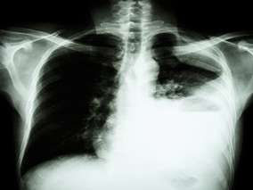 利妥昔单抗对RA相关的间质性肺疾病的进展有何影响？